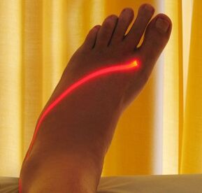 laserová liečba kŕčových žíl na nohách