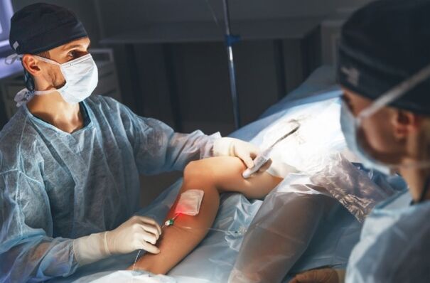 chirurgický zákrok na kŕčové žily laserom