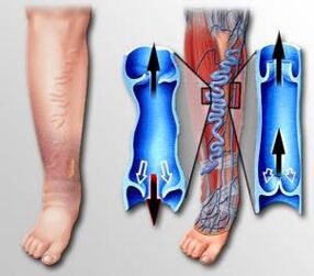 prietok krvi v nohe s kŕčovými žilami
