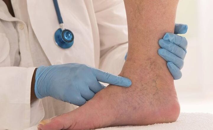 lekár vyšetruje nohu s kŕčovými žilami