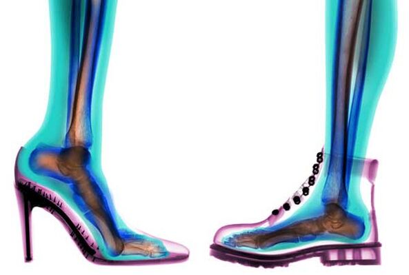 pohodlné a nepohodlné topánky na prevenciu kŕčových žíl