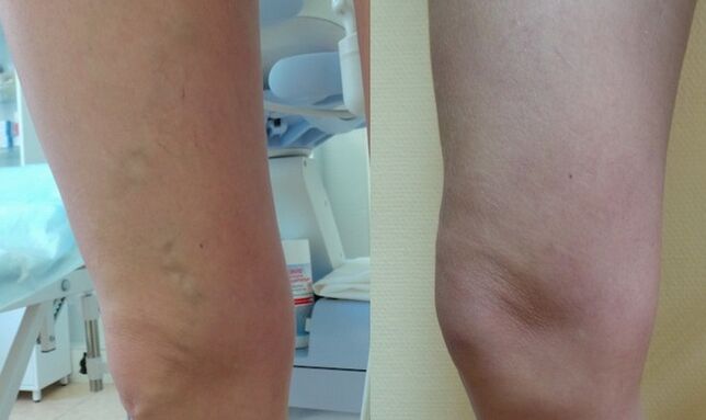 nohu pred a po liečbe retikulárnych kŕčových žíl