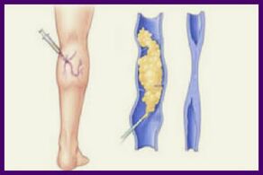 Skleroterapia je populárna metóda, ako sa zbaviť kŕčových žíl na nohách