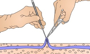 chirurgický zákrok na kŕčové žily