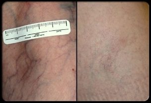 Pred a po procedúre laserovej terapie