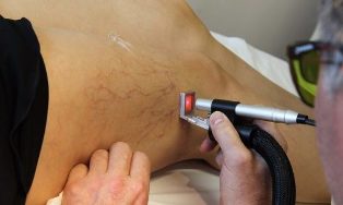 liečba kŕčových žíl laserom