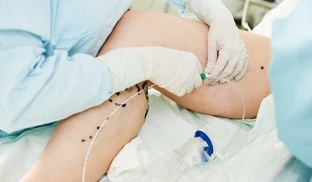 metódy liečby kŕčových žíl na nohách u žien